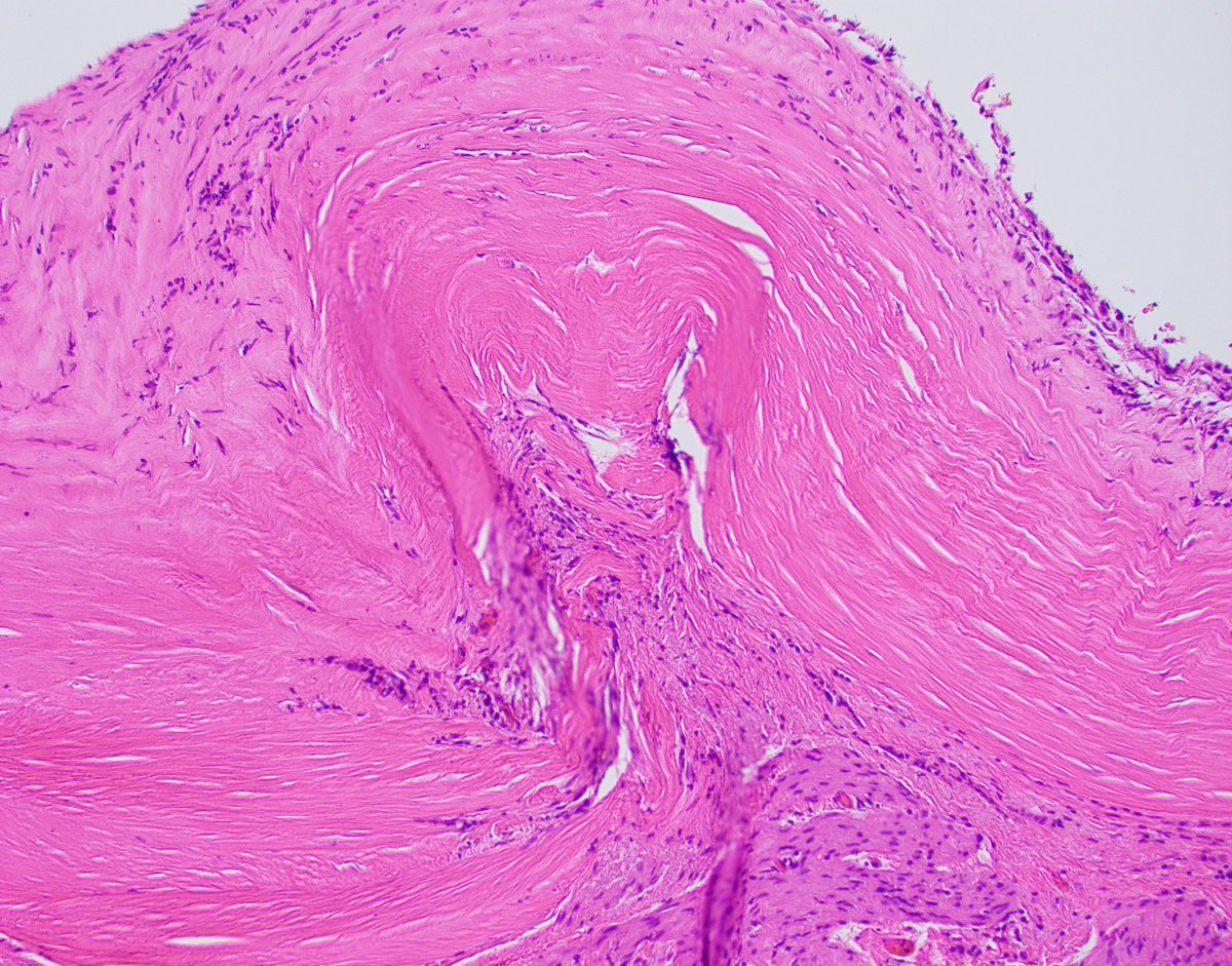 Porcelain gallbladder: Hyaline sclerosis of the gallbladder wall; associated with a slight increased risk of carcinoma. Rare and fascinating! 🩻✨#Pathology #Histopathology #SurgPath #GIPath #PathBoards #PathTweetorial #PathologyCases #pathtwitter #pathx #PathTweetAward