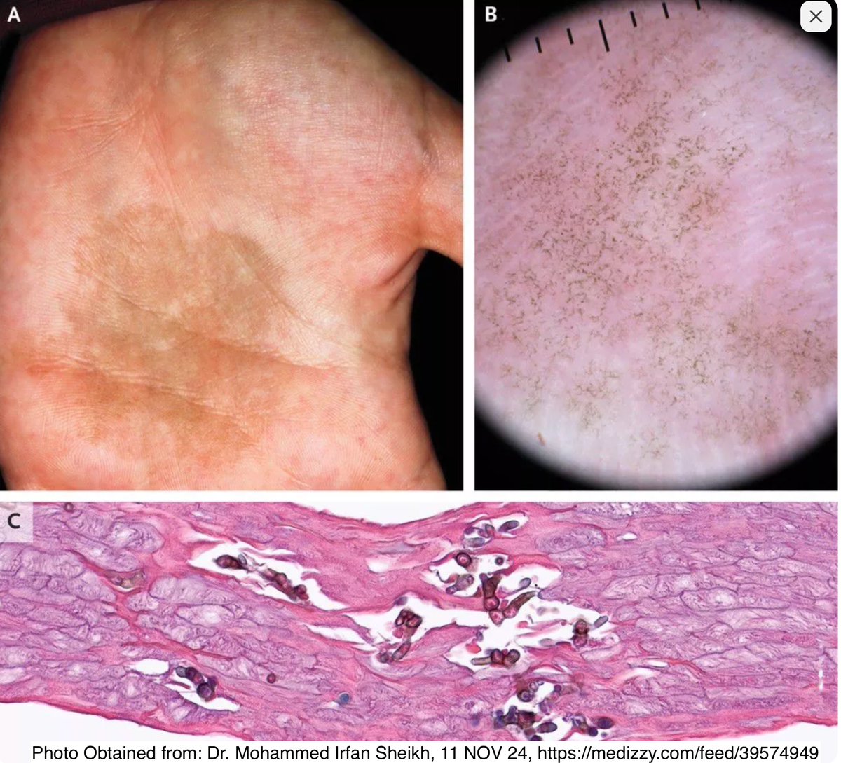 Path4People's tweet photo. I like the palm 🤚 and soles 🦶 

I like tropical ☀️ and subtropical regions

I can mimic acral lentiginous melanoma 😈 

Who am I? 🤔 

#dermpath #pathx #path4people #dermatology #fammed #pathology #pathagonia https://t.co/rQnB0ATLb8