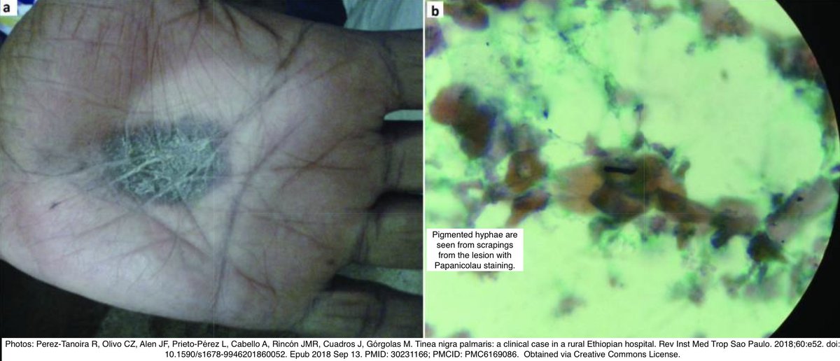 Path4People's tweet photo. I like the palm 🤚 and soles 🦶 

I like tropical ☀️ and subtropical regions

I can mimic acral lentiginous melanoma 😈 

Who am I? 🤔 

#dermpath #pathx #path4people #dermatology #fammed #pathology #pathagonia https://t.co/rQnB0ATLb8
