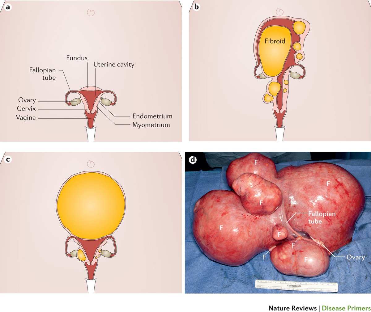 Perempuan yg suka makan dessert cake manis2, ice blended coffee frap milkshake smoothie chocojar crepe apa bagai tu semua, elok lah korang mula baca pasal fibroid.

Pastu baca pasal ovarian cyst. Pastu baca pasal obesity, infertility, mati putik.

Apa punca?

Gula putih. 🍰💀