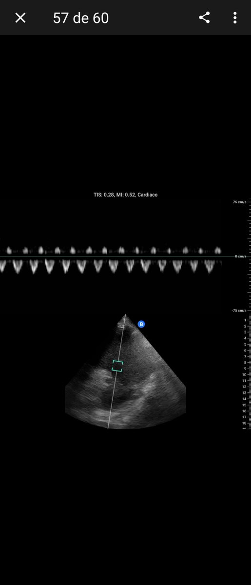 AvelRomanNeph's tweet image. Px #ERC en HDI 2 x sem, datos de ICC descompensada, POCUS ⤵️  disminución contractilidad global, derrame pericardico, punta catéter en #AD, VSH componente sístolico invertido

Aumento dosis diurético (ya con iSGLT2, agrego 1 sesión de HD)

#PocusFirst #Cardionephrology