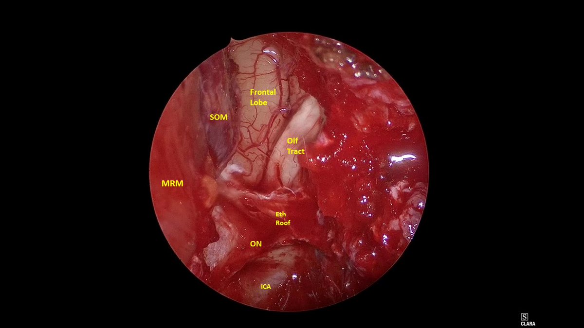 John Craig, MD (@johncraignose) on Twitter photo Don't see this anatomy every day. #SkullBase can include the #Sinuses, #brain, and #orbit after #SNEC resection. Endoscopic resection to preserve the eye is cool. 😎 👃🧠👁️ <a href="/henryfordent/">Henry Ford ENT</a> <a href="/HenryFordNeuro/">Henry Ford Neuroscience</a> Don't see this anatomy every day. #SkullBase can include the #Sinuses, #brain, and #orbit after #SNEC resection. Endoscopic resection to preserve the eye is cool. 😎 👃🧠👁️ <a href="/henryfordent/">Henry Ford ENT</a> <a href="/HenryFordNeuro/">Henry Ford Neuroscience</a>