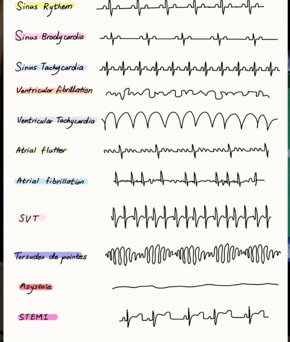 OGdukeneurosurg's tweet photo. EKG https://t.co/cO6zuaQCkT