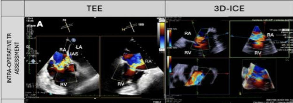 European Society of Cardiology Journals (@esc_journals) on Twitter photo NEWS from #EHJIMP‼️ Do you think 3D ICE increase the understanding of #Tricuspid in #TEER? Read this letter and share your thoughts. Hot topic coming!! bit.ly/4epETjU @jgrapsa <a href="/EZancanaroMD/">Edoardo Zancanaro MD</a> <a href="/EHJIMPEiC/">EHJ-IMP Editor-in-Chief</a> <a href="/alessia_gimelli/">Alessia Gimelli</a> <a href="/s_e_petersen/">Steffen Petersen</a> @shehabanwer @eacvipresident NEWS from #EHJIMP‼️ Do you think 3D ICE increase the understanding of #Tricuspid in #TEER? Read this letter and share your thoughts. Hot topic coming!! bit.ly/4epETjU @jgrapsa <a href="/EZancanaroMD/">Edoardo Zancanaro MD</a> <a href="/EHJIMPEiC/">EHJ-IMP Editor-in-Chief</a> <a href="/alessia_gimelli/">Alessia Gimelli</a> <a href="/s_e_petersen/">Steffen Petersen</a> @shehabanwer @eacvipresident