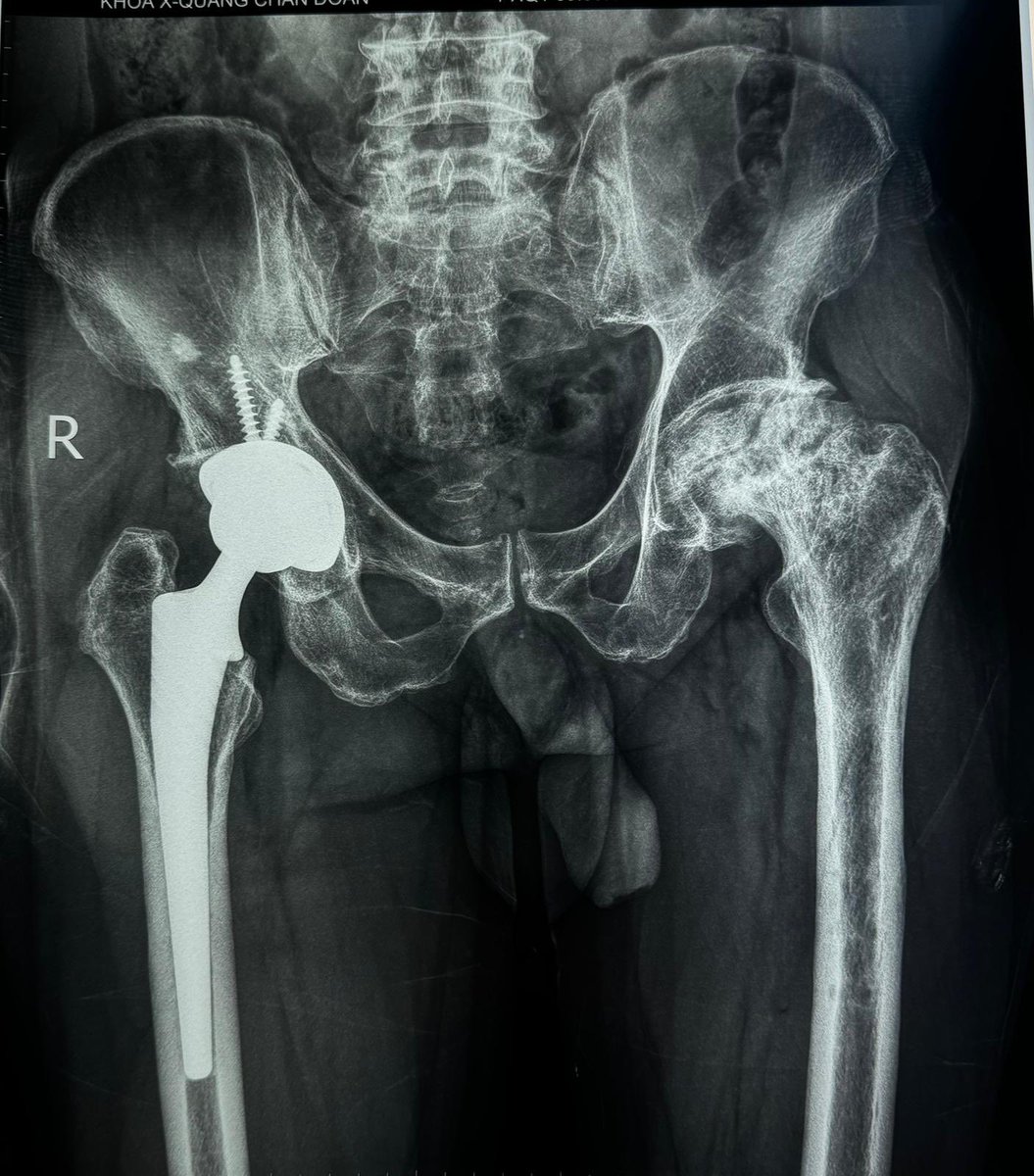 uocuk2's tweet photo. The sun sets on Day 2 of #OperationWalkIreland, and we are proud to share that our team has successfully completed 16 joint replacements today!💪 @OpWalkIreland 

#JointReplacement #Charity #Hanoi #Vietnam #KneeSurgery #HipSurgery #EachStepWeCare #Orthotwitter #medtwitter https://t.co/ryE9lx70Gy