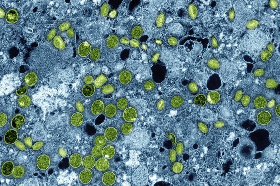 ScienceInsider_'s tweet photo. 🦠 UK Reports New Mpox Variant Cases

British health officials have identified four cases of a new, more infectious mpox variant—the first time outside Africa. The first case was detected in London, with other cases in the same household. The variant causes milder, less noticeable symptoms, raising concerns about undetected spread. The World Health Organization has been monitoring this variant due to its rapid transmission in African countries.

Source: AP News