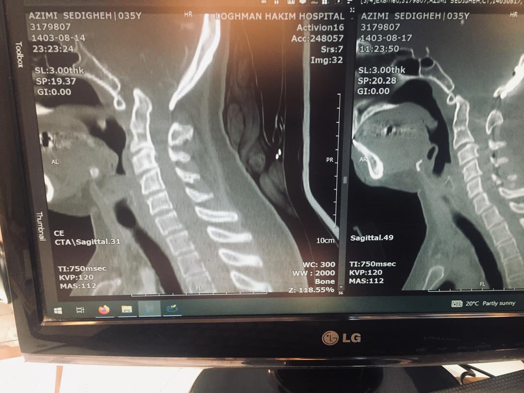 GuiveSharifi's tweet photo. Basilar invagination in young man corrected with DCER technique.amount of invagination corrected, is predicted by CT and compensated by cage placement between facet of c2 and assimilated atlas. #basilar_invagination #axis #atlas #craniovertebral #DCER https://t.co/jzO6Sc6Cug