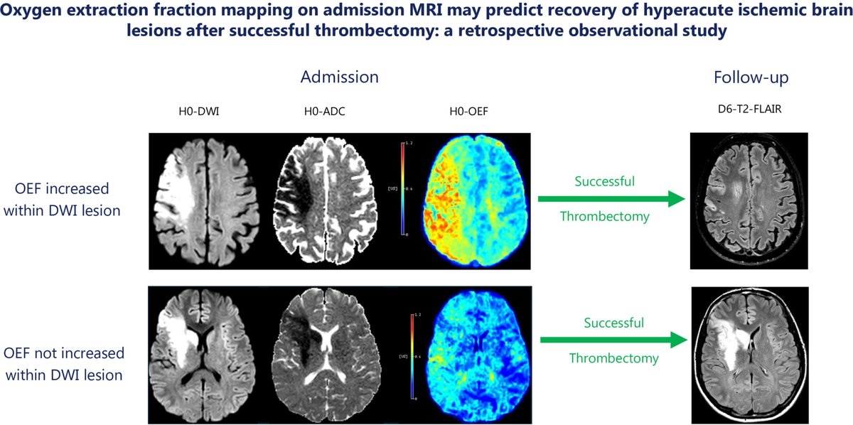 #STROKE November Cover Figure: Is it time to rethink the ischemic core in MRI? Acute ischemic DWI lesions with high OEF may recover after successful thrombectomy. #DWI #OEF #Perfusion #Thrombectomy #Neuroimaging #AHAJournals ahajrnls.org/3Z3eFzo