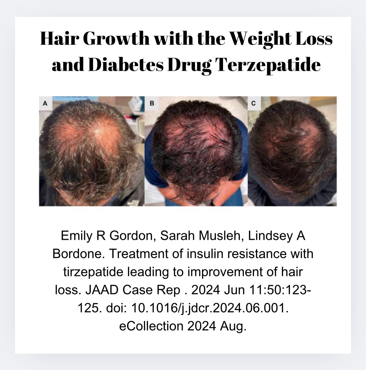 tirzepatide and hair growth In this week's episode of the Evidence Based Hair Podcast, I delve into a  fascinating study offering proof of principle that medications targeting  insulin resistance could offer new strategies for hair growth