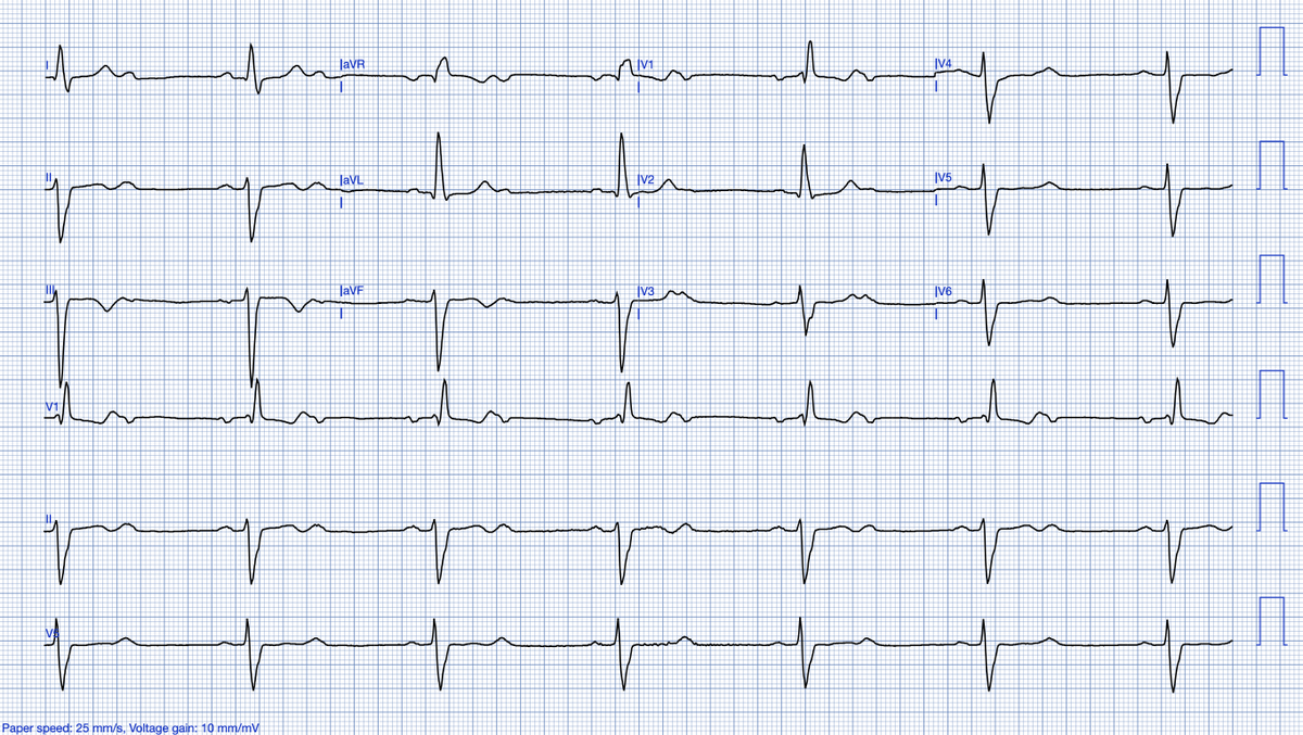 smithECGBlog's tweet photo. 2nd degree AV block: is this Mobitz I or II? And why the varying P-P intervals?

https://t.co/Rx6wv5yWYX

@willyhfrick https://t.co/9jTQdzbS9g
