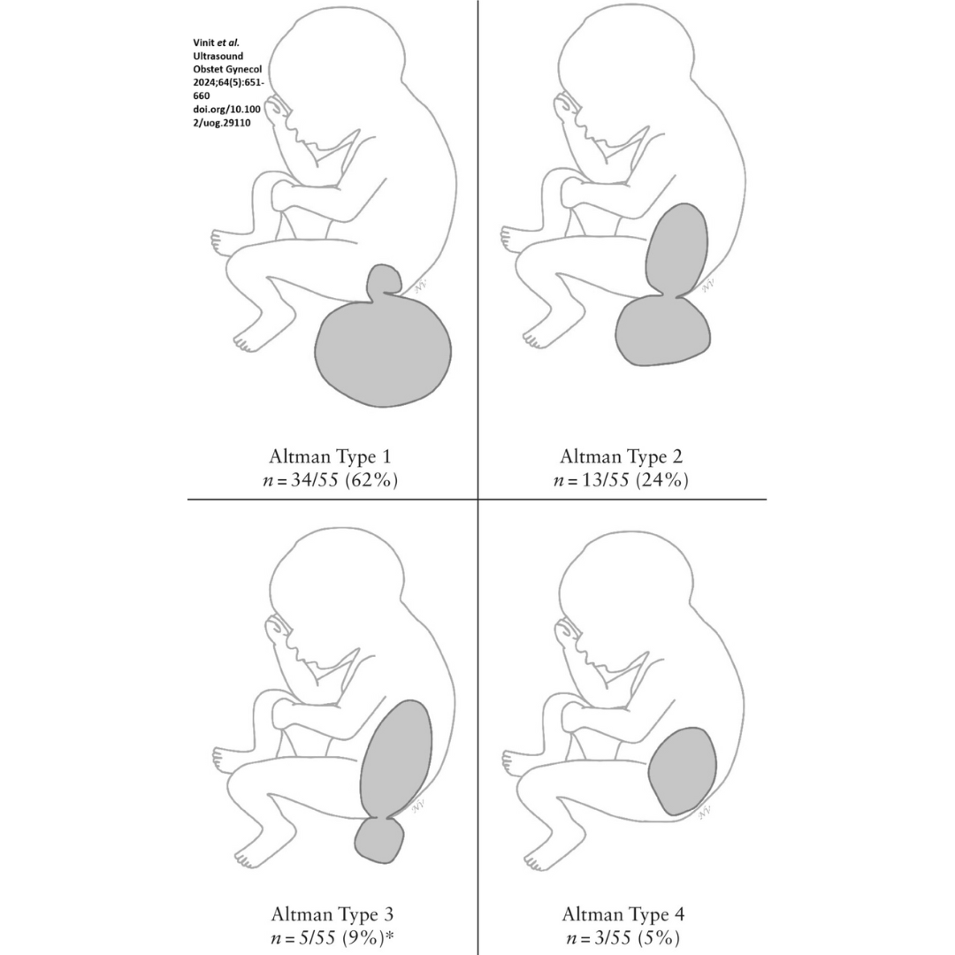 Vinit et al. report that ~30% of fetuses with isolated sacrococcygeal teratoma have a poor perinatal outcome, and that tumor growth velocity seems associated independently with poor perinatal outcome. Read the open access article in #UOGJournal: bit.ly/4fvAwES