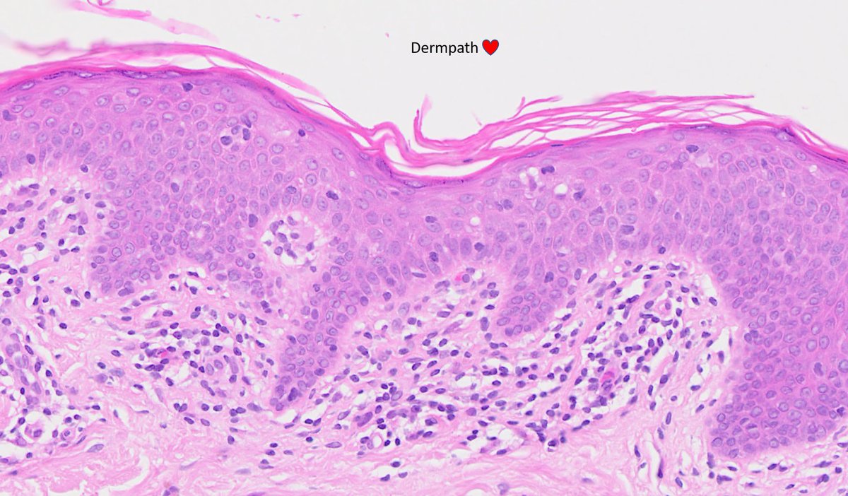 Double bubble. Middle aged male, lesion 1 = plaque on face ? BCC  (first 2 images), lesion 2 = ?LS ?MF (2nd 2 images). dx? #dermpath