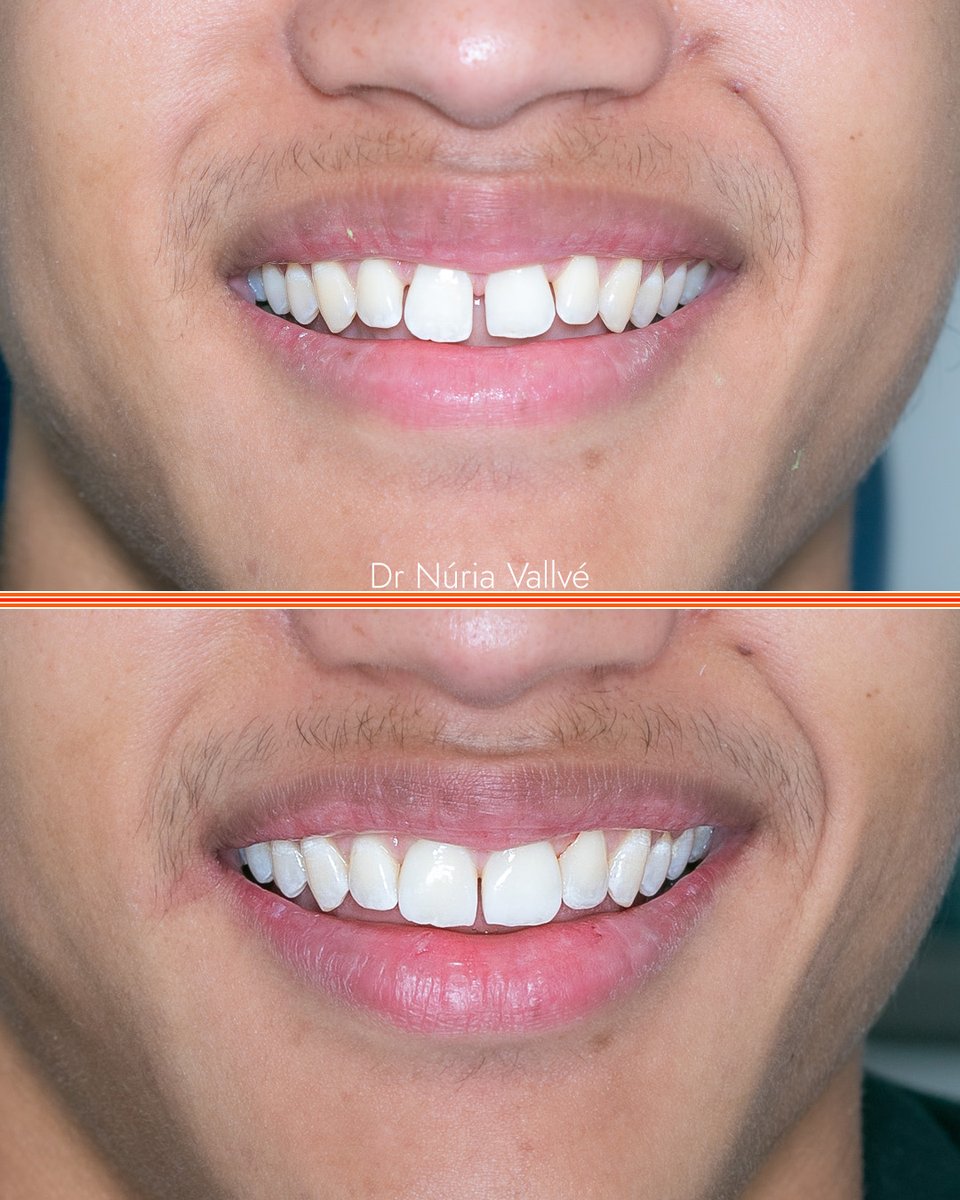 Tailored Smile Transformation
Conor wanted a subtle change, keeping his natural gap while enhancing symmetry. With composite bonding, Dr. Núria Vallvé achieved exactly that. Conor loved the result. Book your free consultation at 3dental.ie/bonding/.