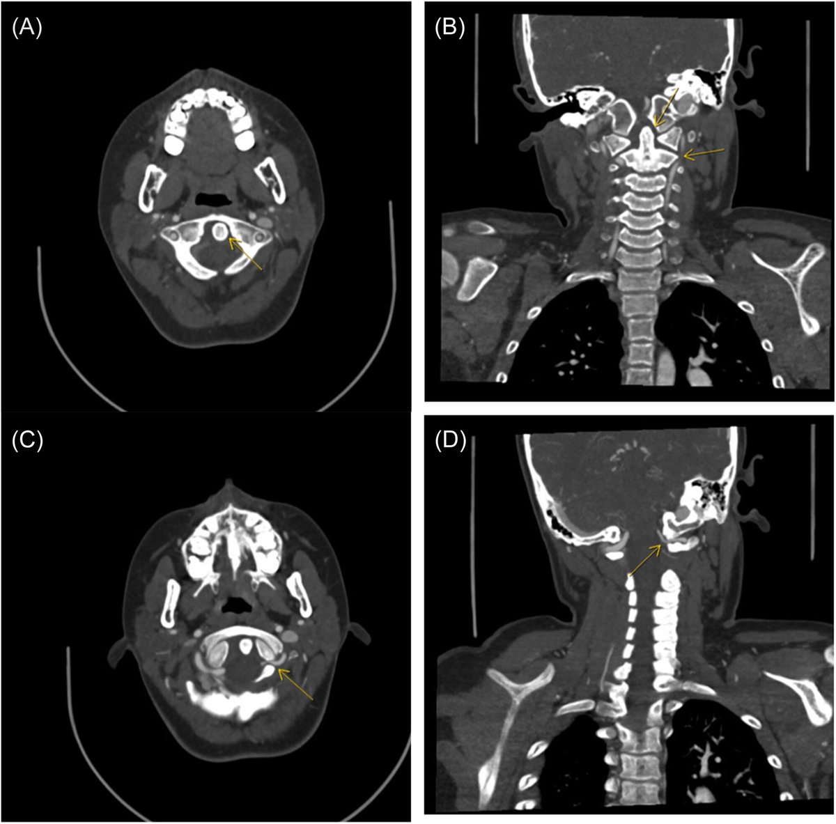 Annals of the Child Neurology Society (@annalscns) on Twitter photo Chrisoula Cheronis et al. of <a href="/Stanford_Neuro/">Stanford Neurology & Neurological Sciences</a> discuss the use of dynamic magnetic resonance angiography in the diagnosis of rotational vertebral artery syndrome: onlinelibrary.wiley.com/doi/10.1002/cn…
<a href="/WileyNeuro/">Wiley Neuro</a> <a href="/Grant_L_Lin/">Grant Lin, MD/PhD</a> Chrisoula Cheronis et al. of <a href="/Stanford_Neuro/">Stanford Neurology & Neurological Sciences</a> discuss the use of dynamic magnetic resonance angiography in the diagnosis of rotational vertebral artery syndrome: onlinelibrary.wiley.com/doi/10.1002/cn…
<a href="/WileyNeuro/">Wiley Neuro</a> <a href="/Grant_L_Lin/">Grant Lin, MD/PhD</a>