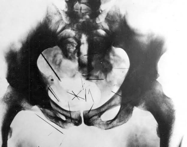 TAdventurousoul's tweet photo. 24. An X-ray of the pelvis of Albert Fish reveals needles he had inserted into his pelvic area for pleasure. https://t.co/lnpBs899Pu