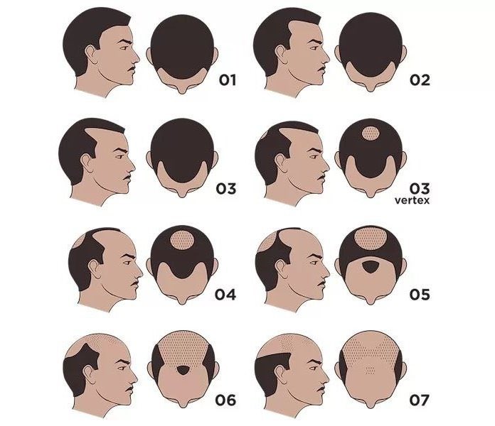 I heard that you have to pass a HAIRfication process to get into <a href="/HairTokenApt/">Hair Token 💈</a> 👀

What's your Norwood type?