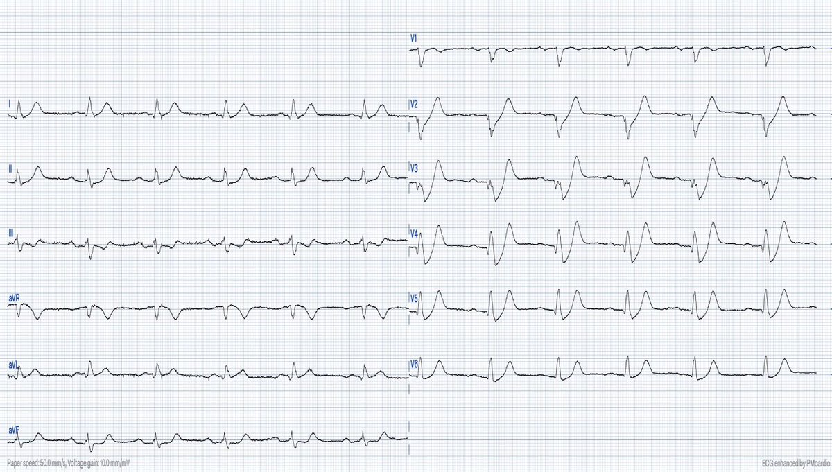 Typical chest pain. What is going on?