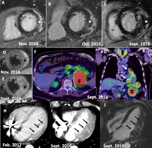 International Journal of Cardiology Heart&Vasc (@ijc_heart_vasc) on Twitter photo A fearsome evolution of presumed cardiac sarcoidosis - the sarcoid lymphoma syndrome🫀
👉first case showing a transition from isolated cardiac sarcoidosis to lymphoma with cardiac involvement
Read all here: bit.ly/3UOfQzQ
<a href="/AmmiratiEnrico/">Enrico Ammirati</a> #CardioEd #CardioTwitter A fearsome evolution of presumed cardiac sarcoidosis - the sarcoid lymphoma syndrome🫀
👉first case showing a transition from isolated cardiac sarcoidosis to lymphoma with cardiac involvement
Read all here: bit.ly/3UOfQzQ
<a href="/AmmiratiEnrico/">Enrico Ammirati</a> #CardioEd #CardioTwitter