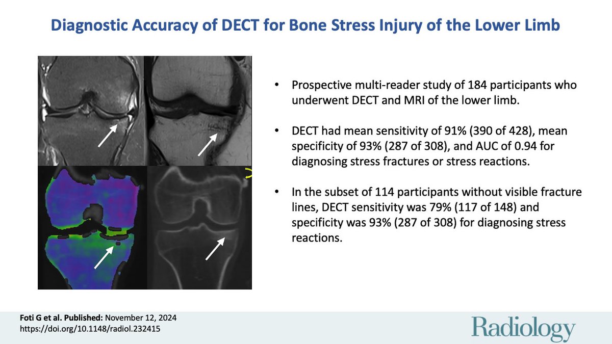 🦴 Dual-energy CT demonstrated high accuracy in diagnosing bone stress fractures and stress reactions in the lower limb—validated against MRI. #Radiology #CT
pubs.rsna.org/doi/10.1148/ra…