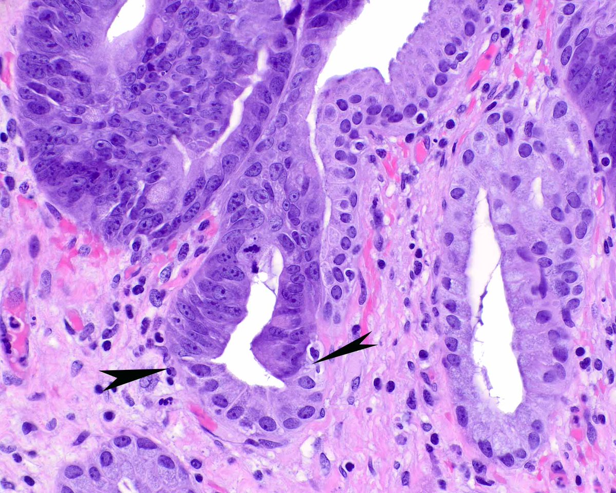 This gallbladder showed high-grade dysplasia, both flat (not shown; Biliary Intra-epithelial Neoplasia/BilIN), and polypoid (intracholecystic papillary neoplasm), but no invasive carcinoma.  Note the abrupt transition between non-dysplastic epithelium and dysplasia. #UMiamiPath
