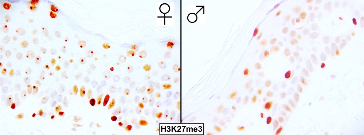 Are you concerned there may have been a mix-up in the lab between two biopsies, where one patient is male and the other female? No worries! Try an IHC for H3K27ME, which stains the Barr body in the nuclei of cells with an XX genotype. Try it to believe it! #pathology #dermpath