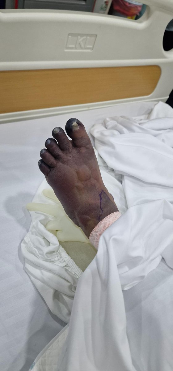HKurusee's tweet photo. Dr. Hussain Shakeel is unfit to practice as a doctor.

Due to his negligence, the leg nerves were severed, nerves to the toes died. He kept this hidden and the family only found about it in India. The woman’s leg had to be amputated. 😢

You owe her compensation, @ADKNashid. https://t.co/LeNxyELAp3