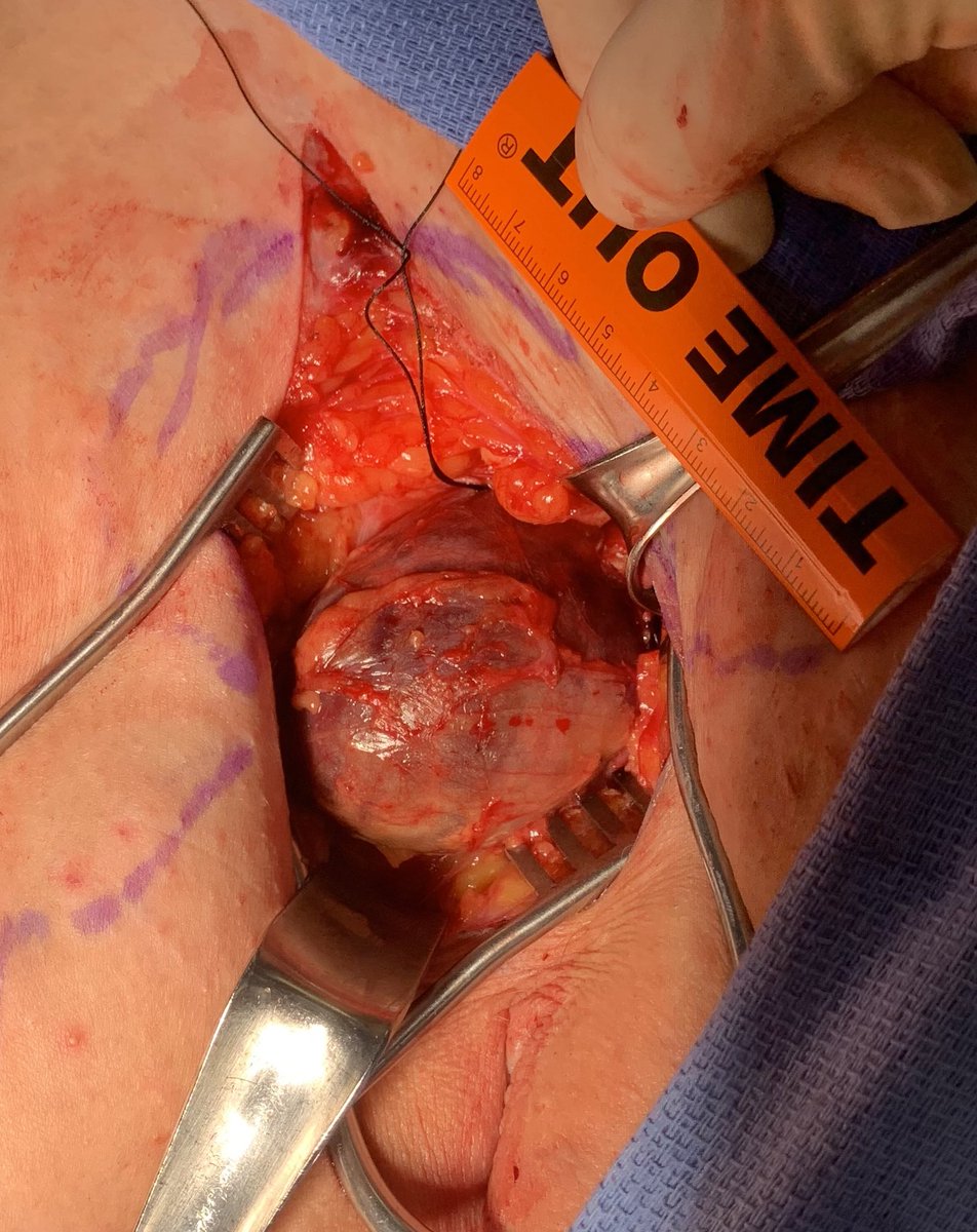 5cm #aneurysm of saphenous vein at junction causing pain.   Patient was offered GSV ablation but wanted a second opinion.  <a href="/VascularSVS/">Society for Vascular Surgery</a> <a href="/FutureVascSurgn/">FutureVascSurgeons</a> #vascular #MEDTwitter