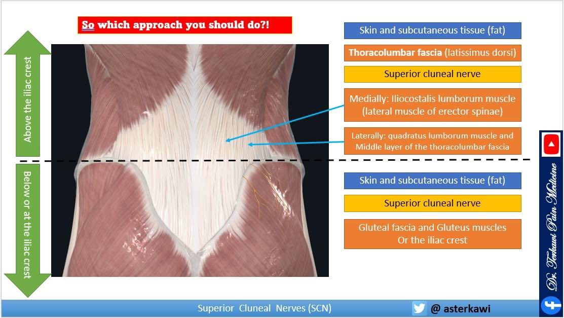 asterkawi's tweet image. All what you need to know about Superior Cluneal Nerves: Neuropathy, Entrapment, Block, and Management: youtu.be/GQS3qFbfgTE
 
Learn and Enjoy!

#ButtockPain #backpain #hippain #NerveBlock #SuperiorClunealNerves #neuropathy