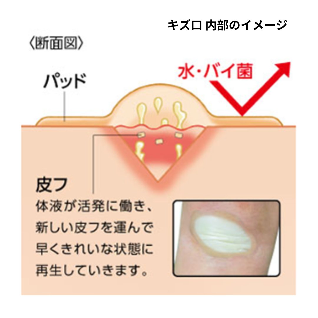 【よくある質問🩹】
Q. キズパワーパッド™は、キズが完治するまで貼った方がいいの？

A. 目安は「キズ口から体液が出てこなくなり、新しい表皮の形成が認められるまで」です！

最長5日間貼り続けることが可能ですが、2-3日に一度はキズの様子を観察し、感染を示す症状がないか確認してくださいね！
