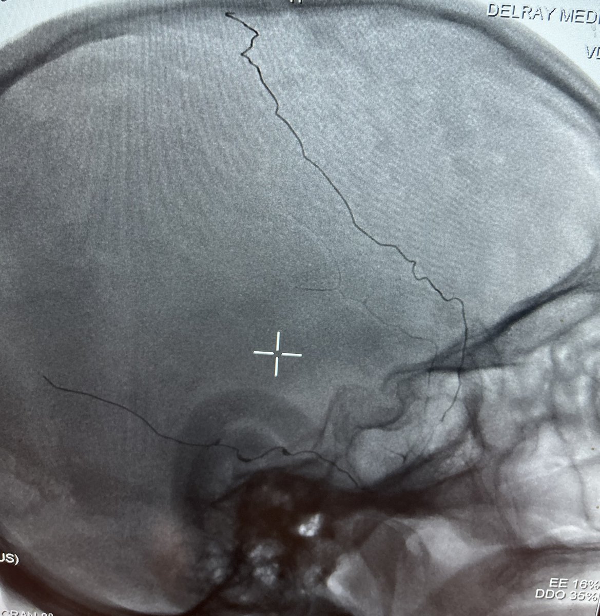 PenNeuro's tweet photo. US HCPs: Designed to fill densely like #liquidmetal: 2 #swiftPAC packing coils deployed in the distal frontal and parietal MMA branches. Courtesy of @DennysReyesMD! 

Rx only. Risk: https://t.co/hzWEQEQmfZ Clinical results may vary https://t.co/uHG9Xlh90v