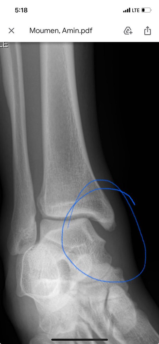 Had a great surgery today! Thank you to everyone who has been by my side through this process❤️‍🩹. It’s unfortunate that this was the way my season had to end, I would do anything to play one more game with my brothers but it’s all apart of God’s plan for me!🙏 #A3out