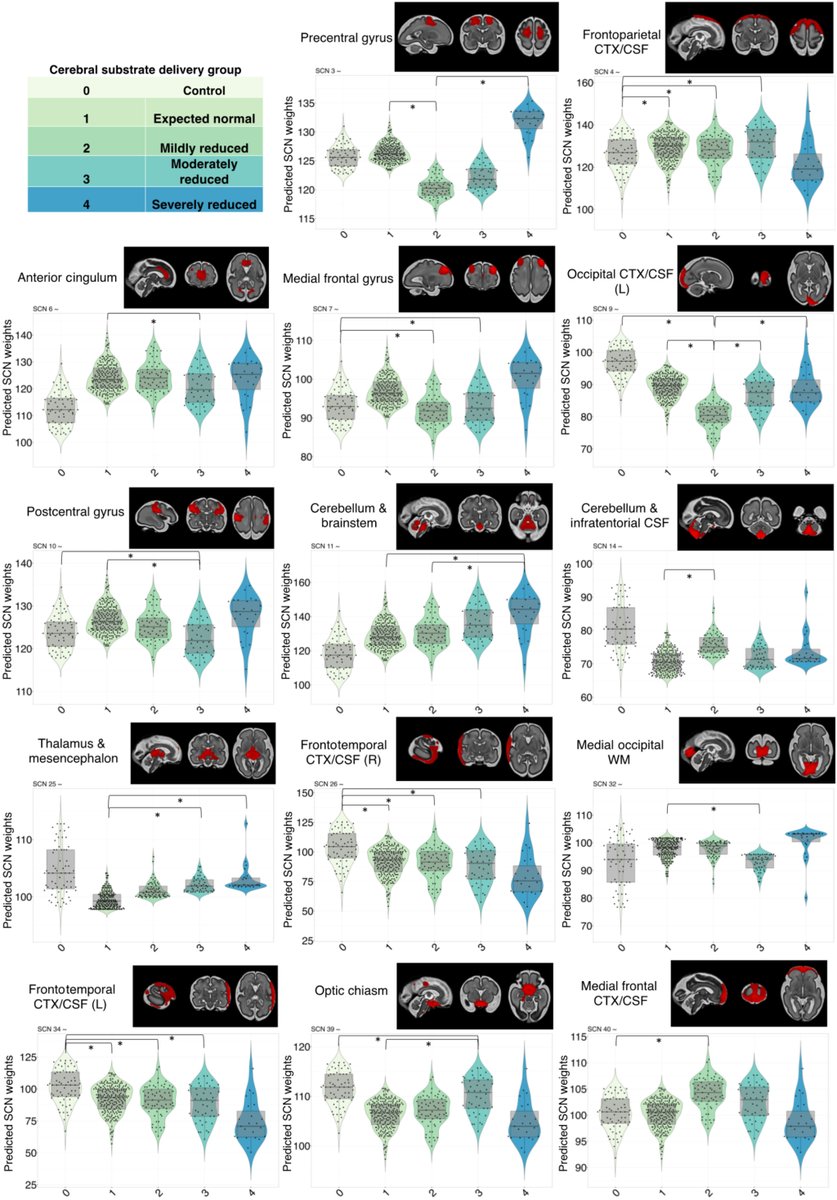 JAHA (@jaha_aha) on Twitter photo Study using structural covariance networks suggests CHD alters brain development in utero, driven by lower oxygen delivery and abnormal fetal hemodynamics. #AHAJournals <a href="/SianWilsonn22/">Dr Siân Wilson</a> <a href="/DanCromb/">Dan</a> <a href="/milou_vp/">Milou van Poppel</a> <a href="/k_pushparajah/">Kuberan Pushparajah</a> <a href="/dfalloyd/">Dr David F A Lloyd</a> ahajrnls.org/3UOhzp2 Study using structural covariance networks suggests CHD alters brain development in utero, driven by lower oxygen delivery and abnormal fetal hemodynamics. #AHAJournals <a href="/SianWilsonn22/">Dr Siân Wilson</a> <a href="/DanCromb/">Dan</a> <a href="/milou_vp/">Milou van Poppel</a> <a href="/k_pushparajah/">Kuberan Pushparajah</a> <a href="/dfalloyd/">Dr David F A Lloyd</a> ahajrnls.org/3UOhzp2