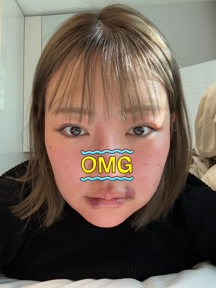 fromrikapanda's tweet photo. 韓国でウルセラ/ボルニューマ/リズネ/ジュベルック一気にやったビフォアフがやばすぎる。すべてiPhone16pro内カメ無加工

←                                                   →
施術前日　　　　　　　施術2日後
施術当日Before              DT

目まで腫れてどう森の蜂に刺された子😇一気施術NG https://t.co/aSe2HMf7oS