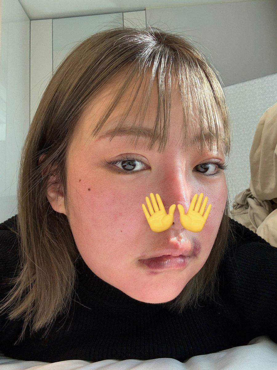 fromrikapanda's tweet photo. 韓国でウルセラ/ボルニューマ/リズネ/ジュベルック一気にやったビフォアフがやばすぎる。すべてiPhone16pro内カメ無加工

←                                                   →
施術前日　　　　　　　施術2日後
施術当日Before              DT

目まで腫れてどう森の蜂に刺された子😇一気施術NG https://t.co/aSe2HMf7oS