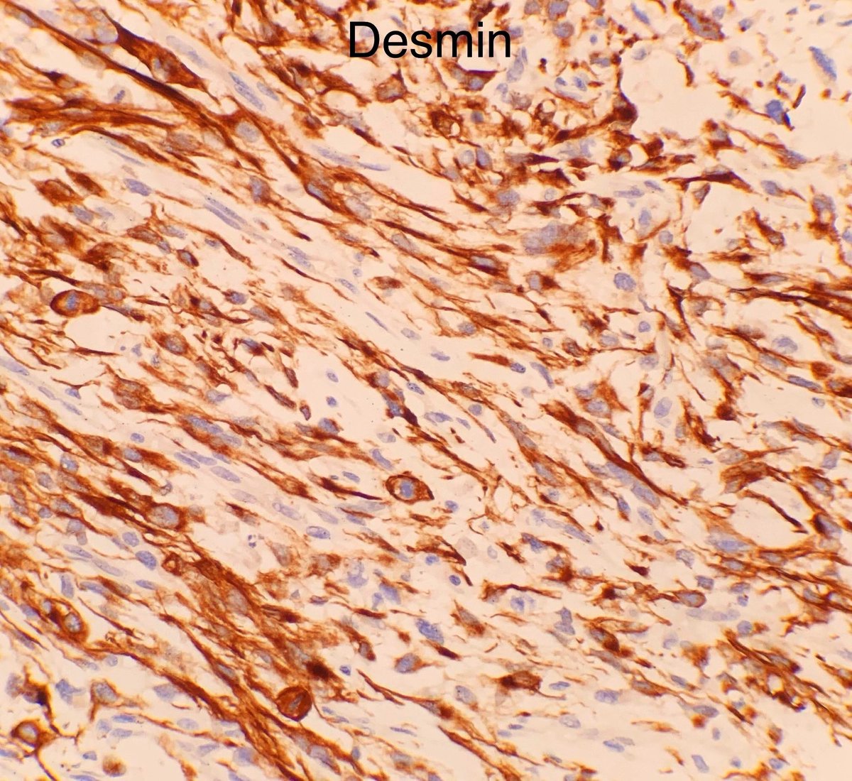 🟪Uterine myxoid leiomyosarcoma🟪

Macroscopic:
➡️Appearance is often gelatinous or glistening 

Histopathology:
➡️Myxoid stroma 
➡️Vague fascicular growth 

Diagnostic criteria 🔬(1 or more of the following):
➡️Tumour necrosis 
➡️Moderate to severe cytological atypia
➡️&gt;1