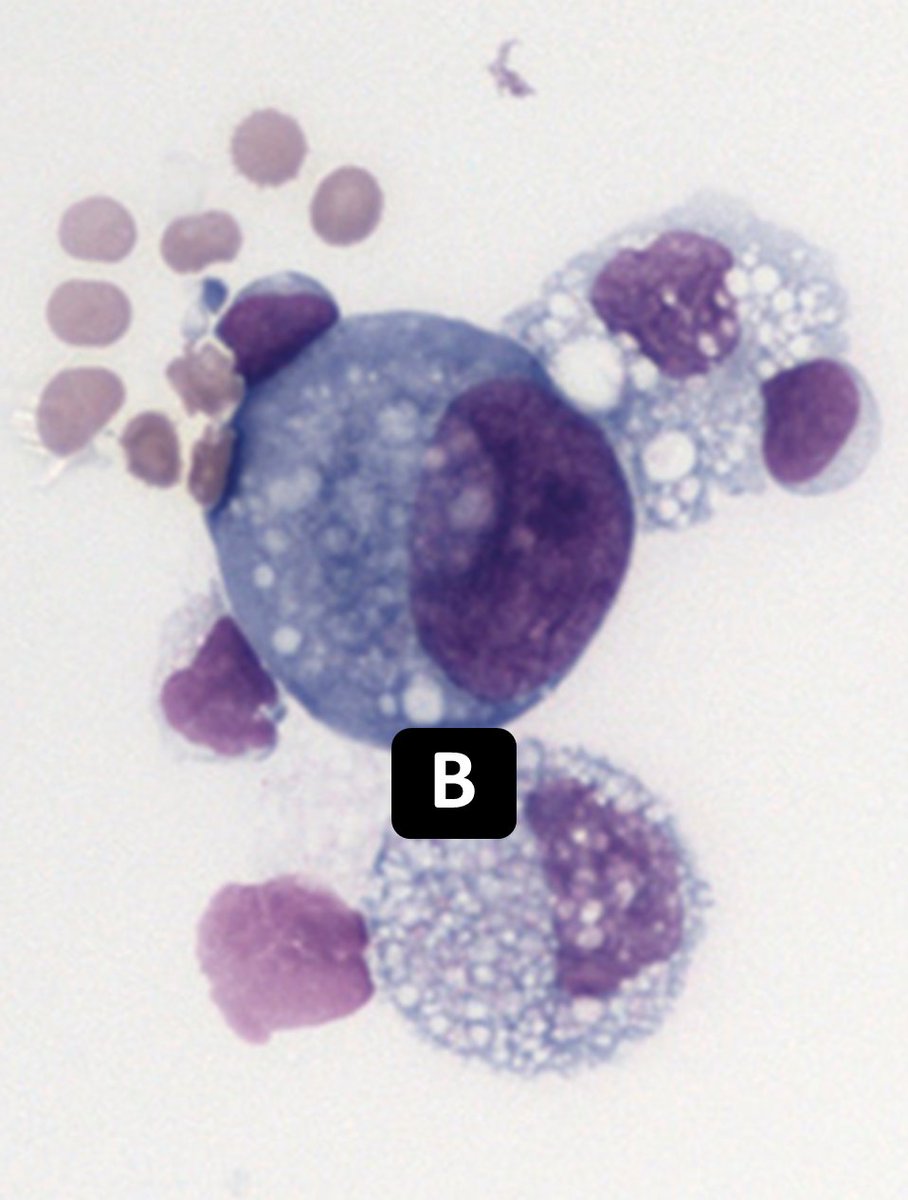 Two signet rings, which one is malignant?
#CytoPath #PathTwitter #Pathology
🙏pmc.ncbi.nlm.nih.gov/articles/PMC90…