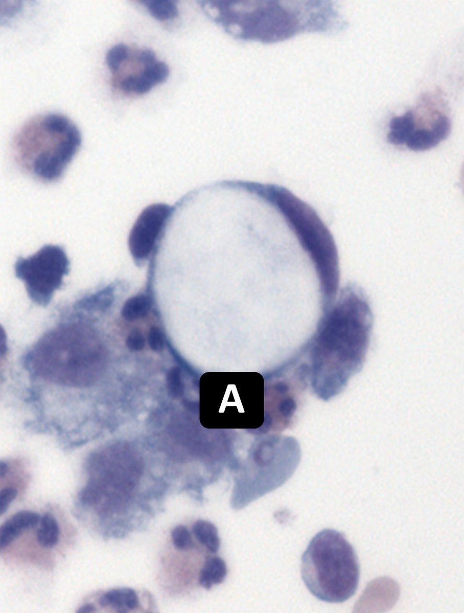 DrCycloPath's tweet photo. Two signet rings, which one is malignant?
#CytoPath #PathTwitter #Pathology
🙏https://t.co/0JsBFRmai1 https://t.co/SoyVEBs9Nc