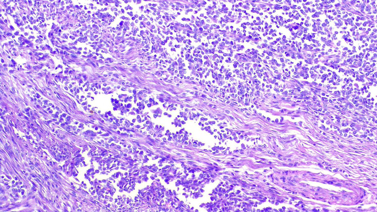 _Wondweson64's tweet image. A 30 Yr | 👩
 🎯 SiTe: Recto-Sigmoid
   🔪CuT: A 6x3cm punched out Ulcerating Mass with raised borders
🔬DiAgNoSis?

#Pathresidents #Pathology #Path2Path #PathTwitter #GIpath @Pathologists #pathx