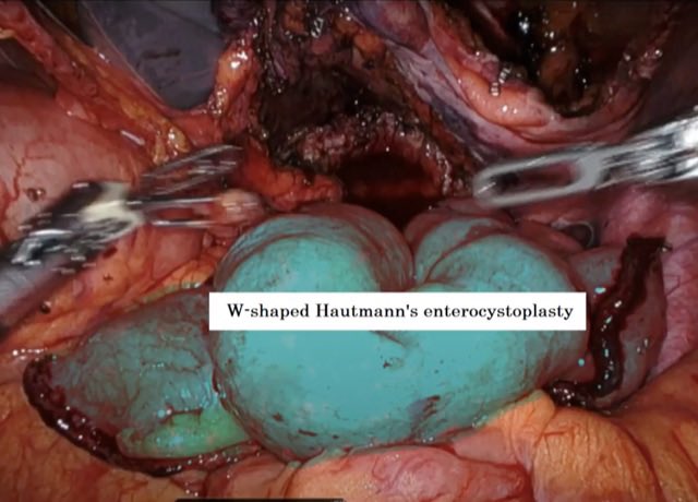 Véronique Phé (@pheveronique) on Twitter photo 🎉Our last paper on robotic surgery for #neurogenicbladder
👉Potential advantages over open approach
✅Lower high-grade postoperative complications
✅Decreased length of hospitalisation & estimated blood loss
✅Faster recovery
🔴High quality studies needed
<a href="/eau_yuo/">EAU Young Urologists</a> <a href="/EAUYAUrology/">EAU Young Academics</a> 🎉Our last paper on robotic surgery for #neurogenicbladder
👉Potential advantages over open approach
✅Lower high-grade postoperative complications
✅Decreased length of hospitalisation & estimated blood loss
✅Faster recovery
🔴High quality studies needed
<a href="/eau_yuo/">EAU Young Urologists</a> <a href="/EAUYAUrology/">EAU Young Academics</a>
