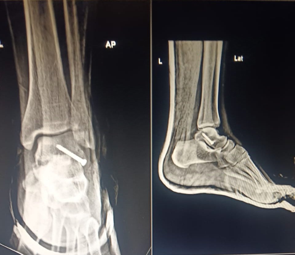 notes_146's tweet photo. Which fracture is this? #xray #ap #ctscan https://t.co/pglyAX2mNc