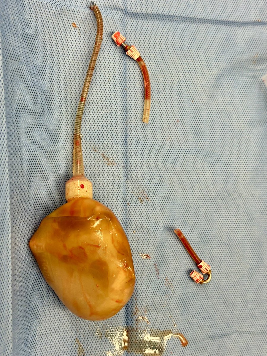 Maia VanDyke, MD (@maiasaurusrex) on Twitter photo I’ve taken out some old implants but never seen anything like these ancient Mentor metal connectors. Nor has anyone I’ve talked to!
Who has seen these bad boys?
<a href="/SMSNA_ORG/">SMSNA</a> <a href="/SocietyGURS/">GURS</a> <a href="/urol11/">rafael carrion corcuera</a> <a href="/drhelenbernie/">Helen L. Bernie</a> <a href="/kfeyer/">Kirk Feyereisen</a> <a href="/alextatem/">Dr. Alex Tatem</a> <a href="/DrPaulPerito/">Perito Urology</a> <a href="/bsc_urology/">Boston Scientific Urology</a> <a href="/Coloplast_MD/">Coloplast Interventional Urology</a> I’ve taken out some old implants but never seen anything like these ancient Mentor metal connectors. Nor has anyone I’ve talked to!
Who has seen these bad boys?
<a href="/SMSNA_ORG/">SMSNA</a> <a href="/SocietyGURS/">GURS</a> <a href="/urol11/">rafael carrion corcuera</a> <a href="/drhelenbernie/">Helen L. Bernie</a> <a href="/kfeyer/">Kirk Feyereisen</a> <a href="/alextatem/">Dr. Alex Tatem</a> <a href="/DrPaulPerito/">Perito Urology</a> <a href="/bsc_urology/">Boston Scientific Urology</a> <a href="/Coloplast_MD/">Coloplast Interventional Urology</a>