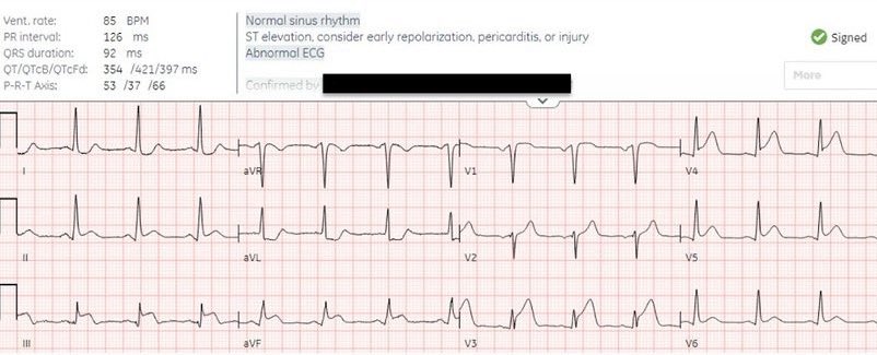 heartsECGcourse's tweet photo. 60 year old with chest pain. Is this early repolarization, pericarditis, or injury?
@ECGcases @EMCases
#ECG #EKG #ECGinterpretation #medstudent #medstudentTwitter #resident #nurse #paramedic #cardiactech #emergencyMedicine #cardioTwitter #foamed #meded #medTwitter #CardioEd https://t.co/KBODgT2Pcv