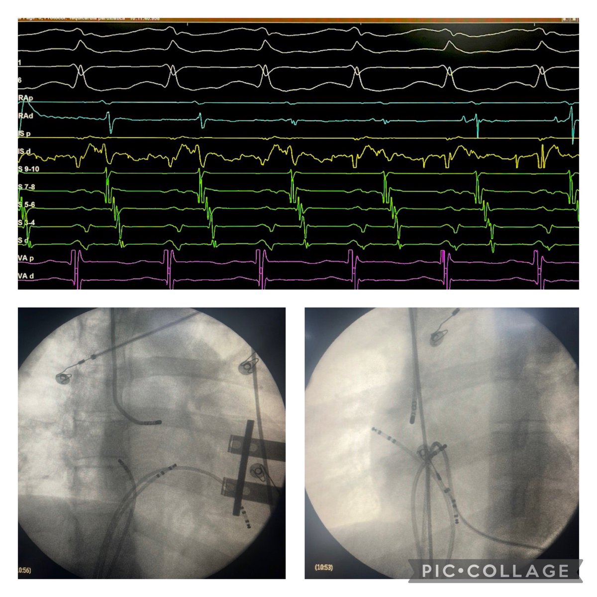 Atypical accessory pathway connection between RAA-RV.

A nice tip here is to recognize what we  coined “fan effect”: a remote place depolarizes HRA-HIS-CSp almost at same time in ORT 
Successful RFA at 3rd session.

<a href="/hospitalposadas/">Hospital Posadas</a>