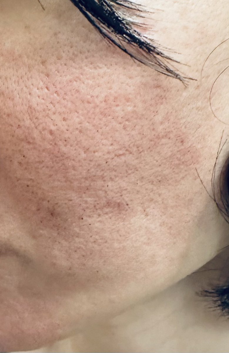 natsuclinic's tweet photo. スタッフ含めた ダウンタイム 色々。
みんな当日夜から翌日が、まる一日すごく痒くて、
3日目にしてようやく痒みが少しマシになりました。 写真はいずれも3日目。
左から
ややしっかり、
かなりしっかり、
かなり軽め。
#ピコレーザー #VMLA https://t.co/w2YDQerHQg