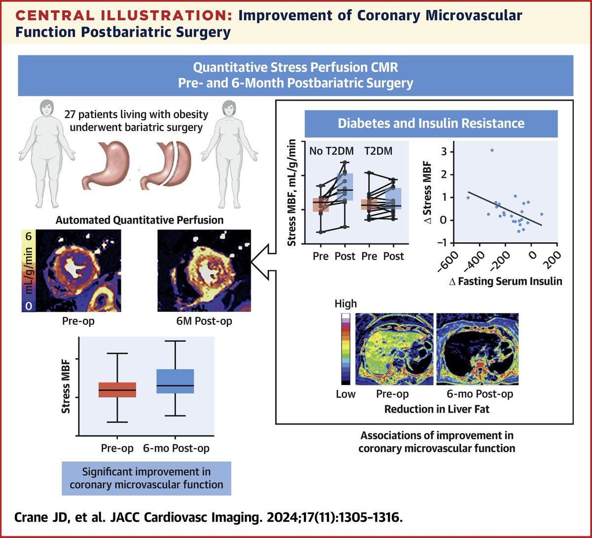 JACC Journals (@jaccjournals) on Twitter photo Coronary microvascular function is impaired in #obesity, but improves by quantitative #whyCMR perfusion 6 months after #bariatric surgery. bit.ly/3AACJA9
#JACCIMG <a href="/sven_plein/">Sven Plein</a> <a href="/DrAChowdhary/">Amrit Chowdhary</a> <a href="/drgeorgejoy/">George Joy</a> <a href="/dr_manisty/">Charlotte Manisty</a> Coronary microvascular function is impaired in #obesity, but improves by quantitative #whyCMR perfusion 6 months after #bariatric surgery. bit.ly/3AACJA9
#JACCIMG <a href="/sven_plein/">Sven Plein</a> <a href="/DrAChowdhary/">Amrit Chowdhary</a> <a href="/drgeorgejoy/">George Joy</a> <a href="/dr_manisty/">Charlotte Manisty</a>