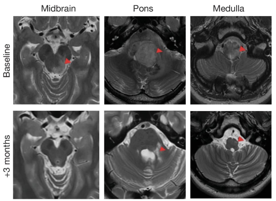 BryanDChoi's tweet image. Significant responses to GD2 CAR T cells in multiple patients with diffuse midline glioma, reported by our colleagues @Stanford in @Nature today. Congrats @michelle_monje and co-authors for this giant leap forward in our field!
nature.com/articles/s4158…