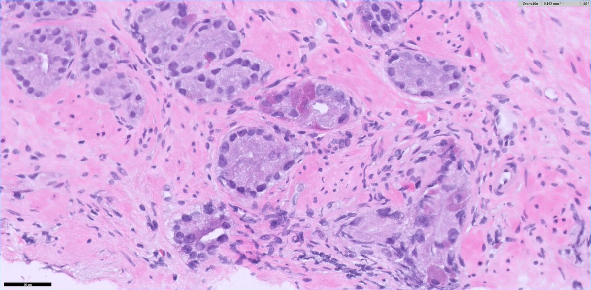 I never get tired of👀🔬prostatic adenocarcinoma with Paneth cell-like change

#GUpath with bonus⏬