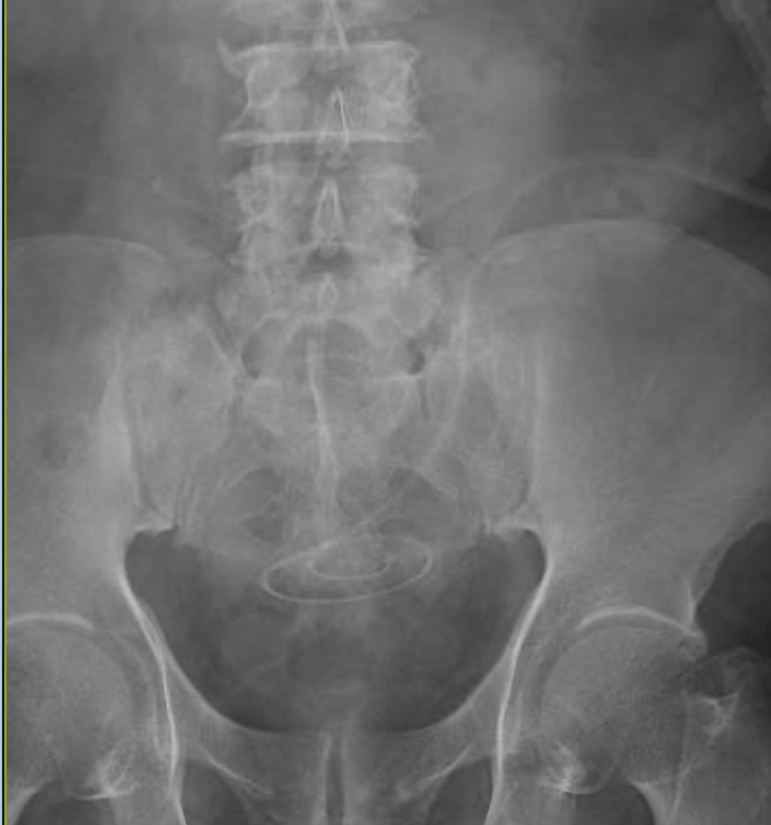 garcia_nefro's tweet image. Colocación  de catéter percutáneo para diálisis peritoneal  por Fellows de Nefrología  Intervencionista @VladimirNephver  @kiro77niker 
#interventionalnephrology #pdfirst