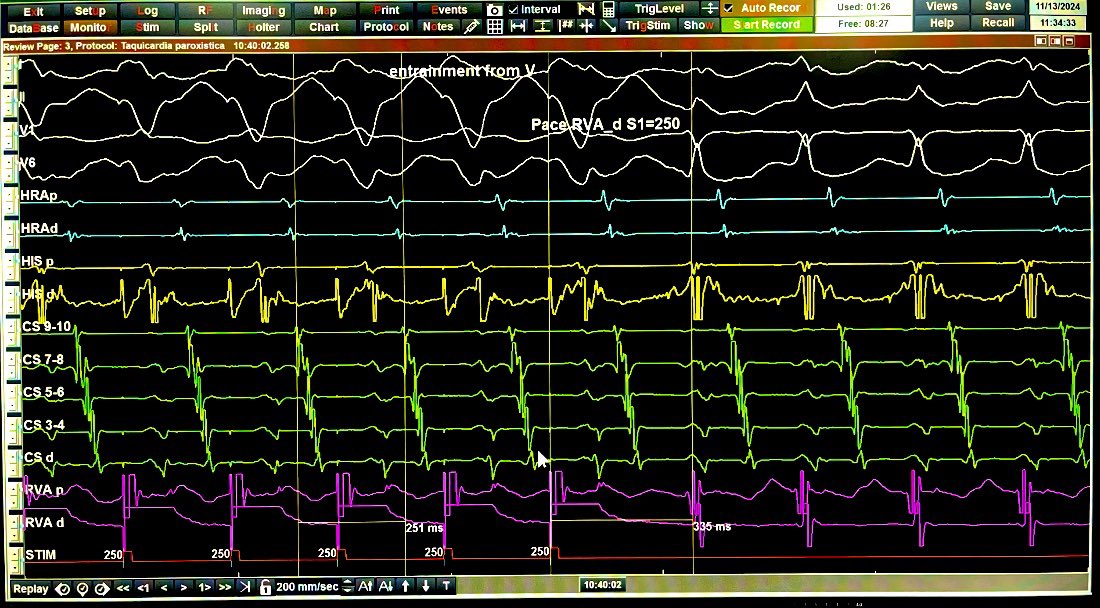 Entrainment from RV rules out Atrial Tachycardia (VAV response)
Very short returning cycle rules out AVNRT