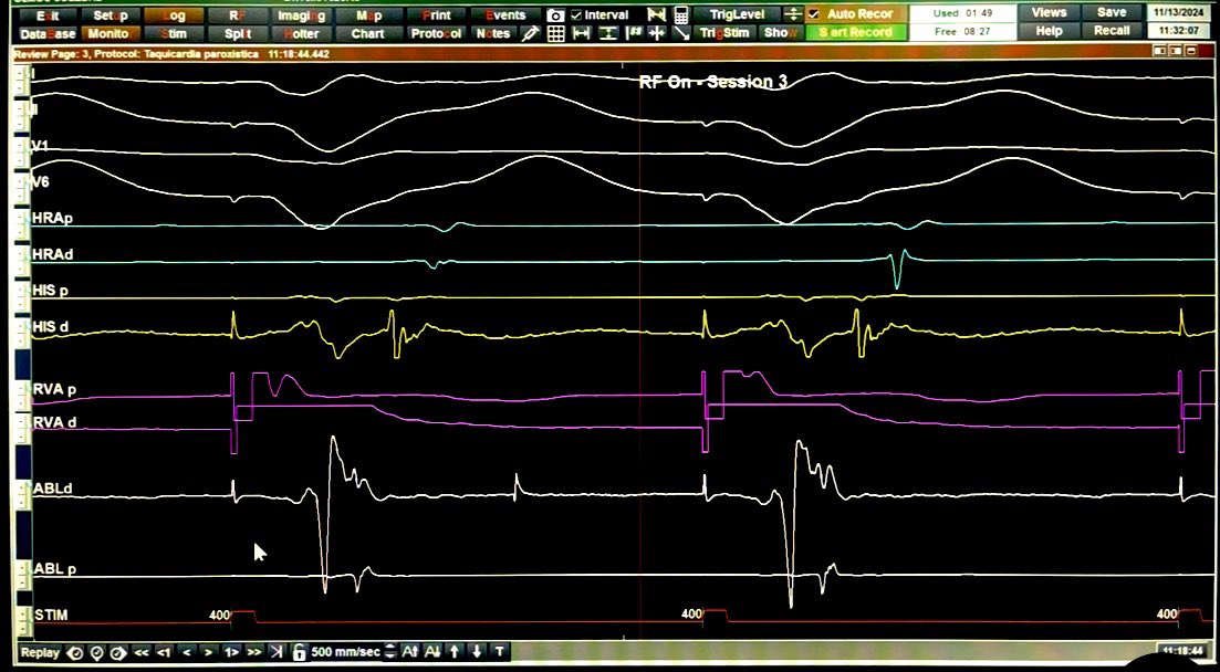 Successful EGM.
Look how early compared to His Channel, the earliest Atrium depolarization in the tricuspid ring.
RAA base location.
Ablation ON Session 3